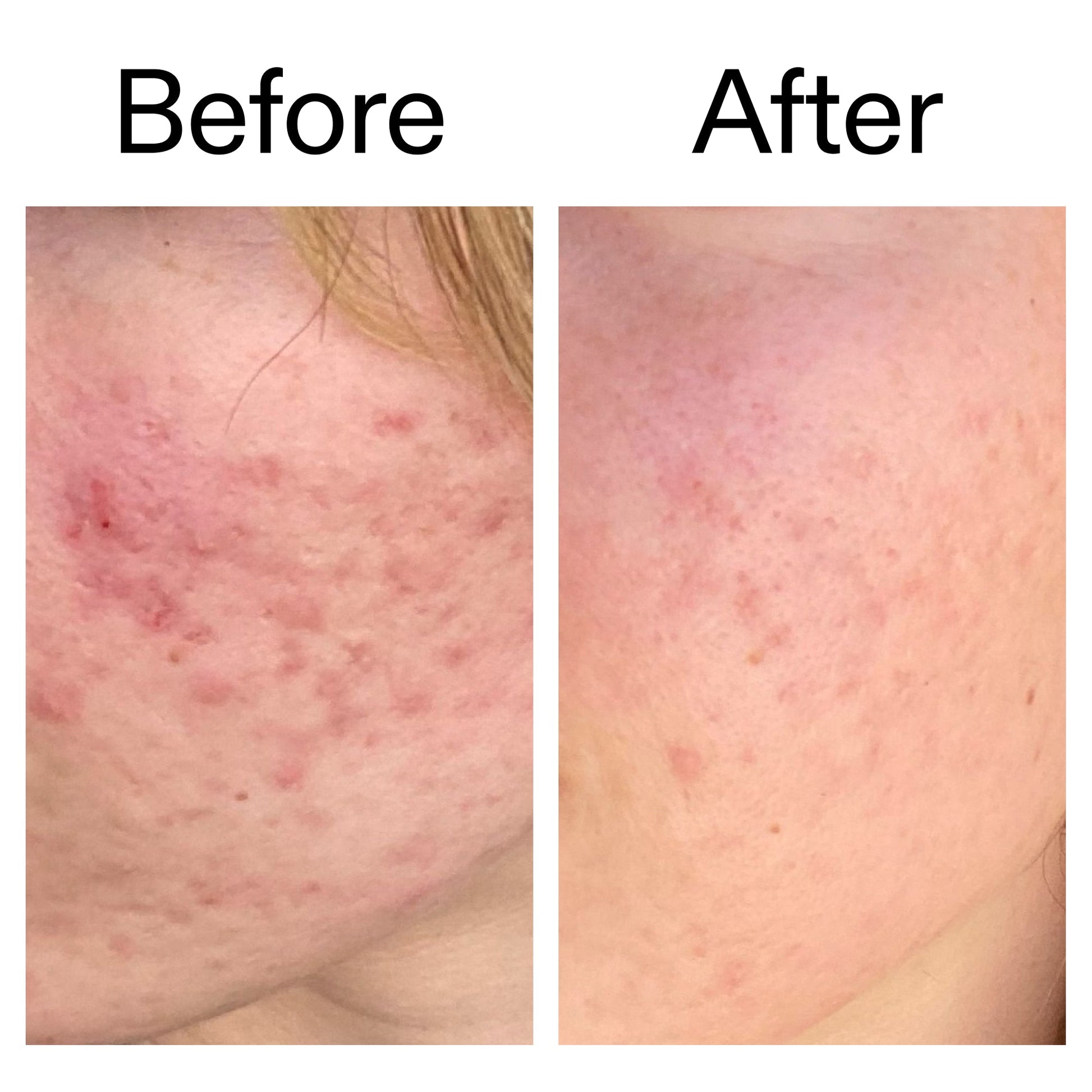 10-azelaic-acid-serum-for-redness-relief-e5 Azealic_Acid_Serum_B_A_Ppage_2000_x_2000.jpg