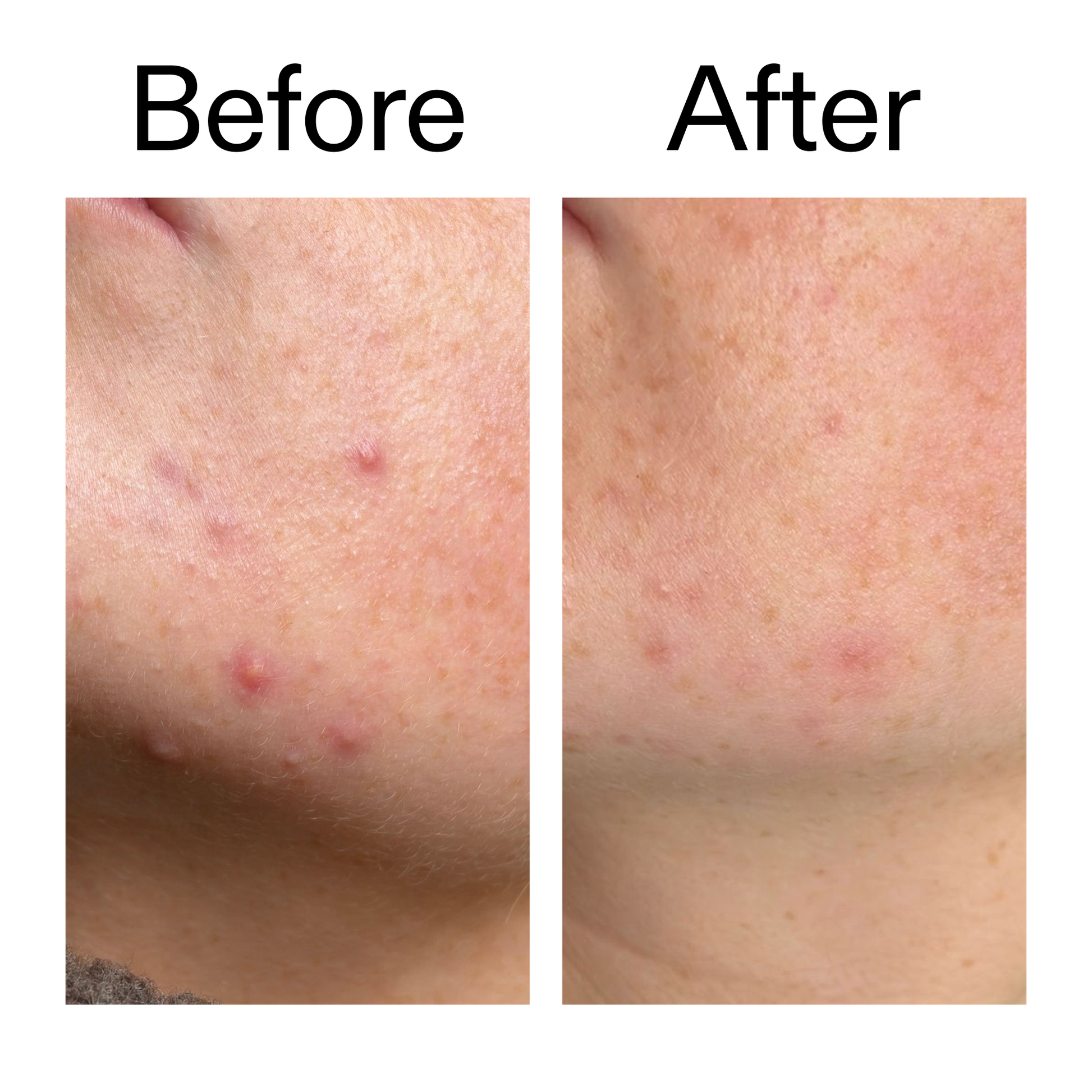 10-azelaic-acid-serum-for-redness-relief-e5 B_A_1_PPAGE.png