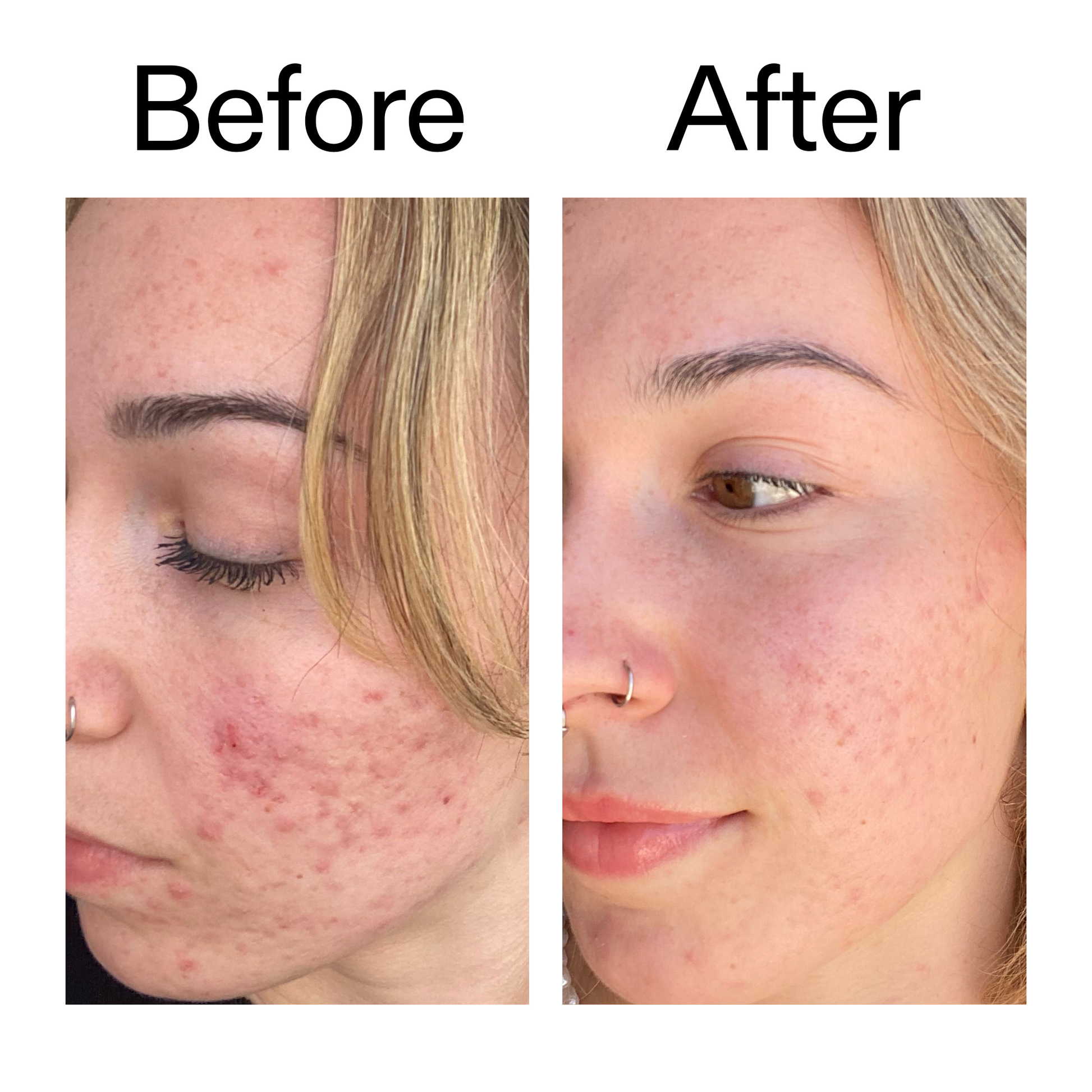 10-azelaic-acid-serum-for-redness-relief-e5 B_A_2_PPAGE.png