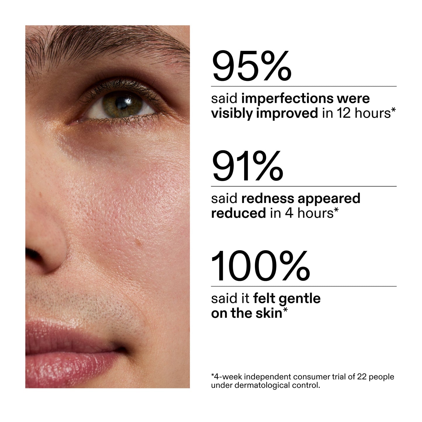 succinic-acid-acne-treatment-y1 CA_Succinic_Acid_Treatment_key_Claims_2000x2000_db91b0f1-7f29-4bfe-bb16-63a47f500960.jpg