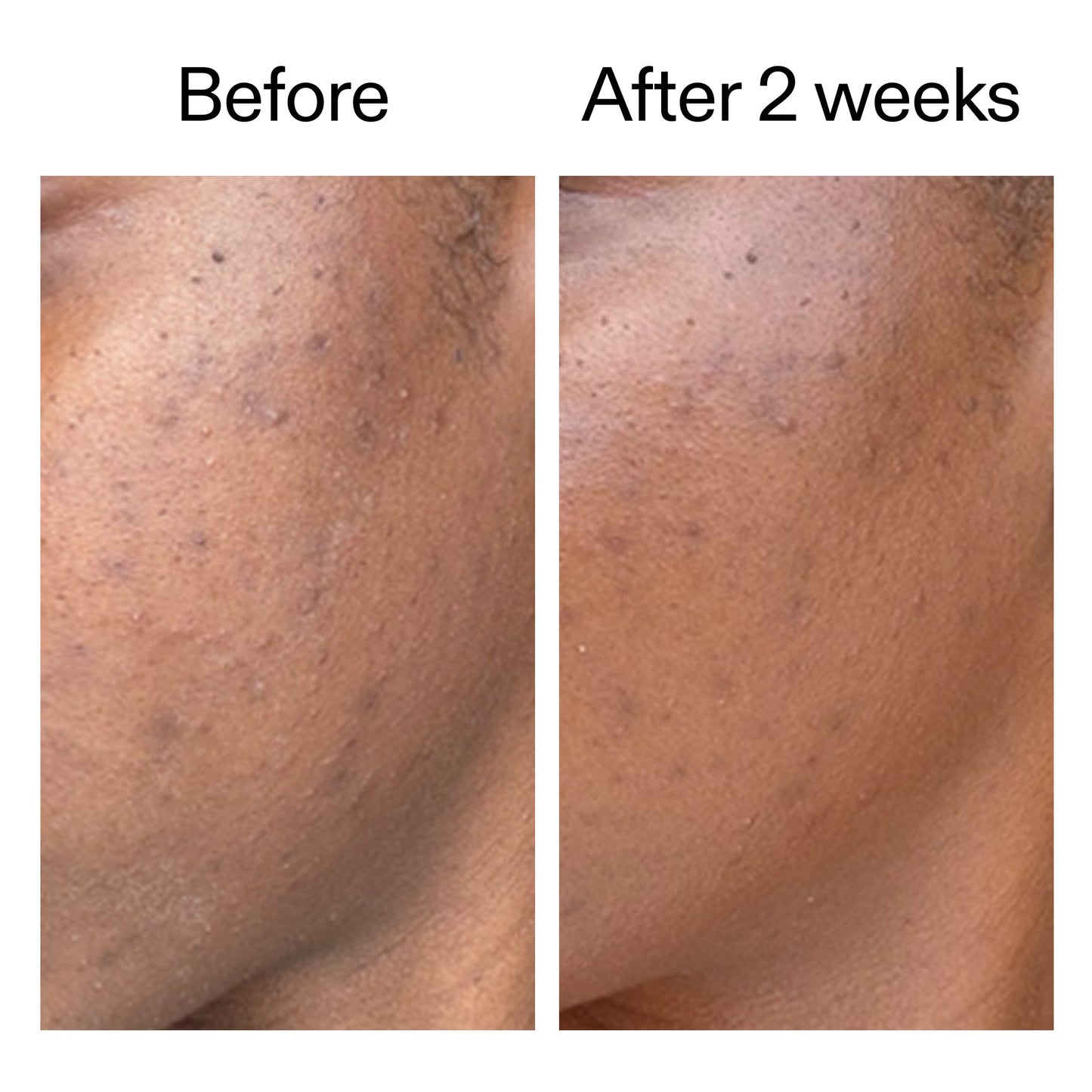 360-acne-clearing-serum-q4 DIOICB_A2000x2000.jpg