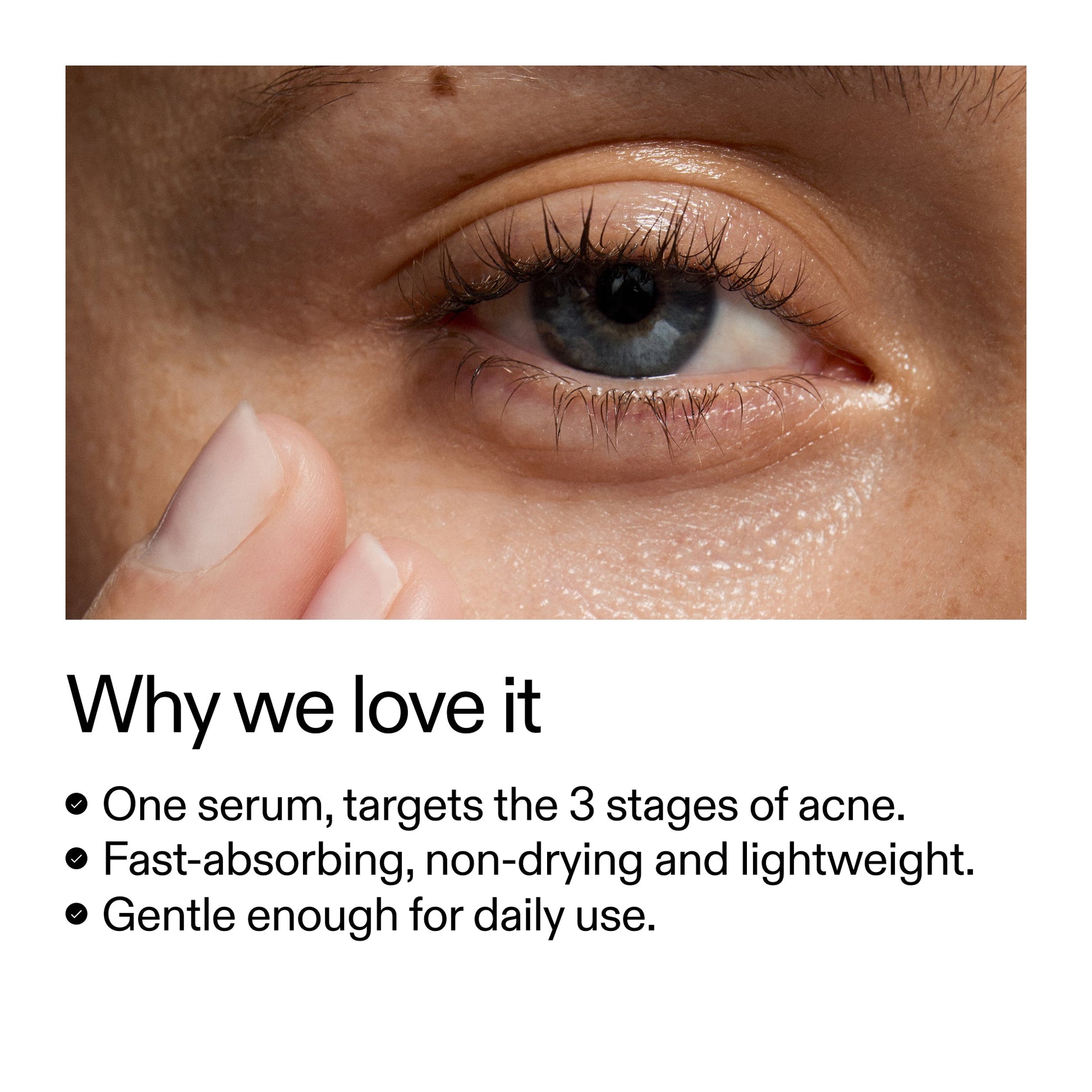360-acne-clearing-serum-q4 Dioic_Whyweloveit_2000x2000_175aafd3-0cbe-403a-b317-a8362881bfe2.jpg