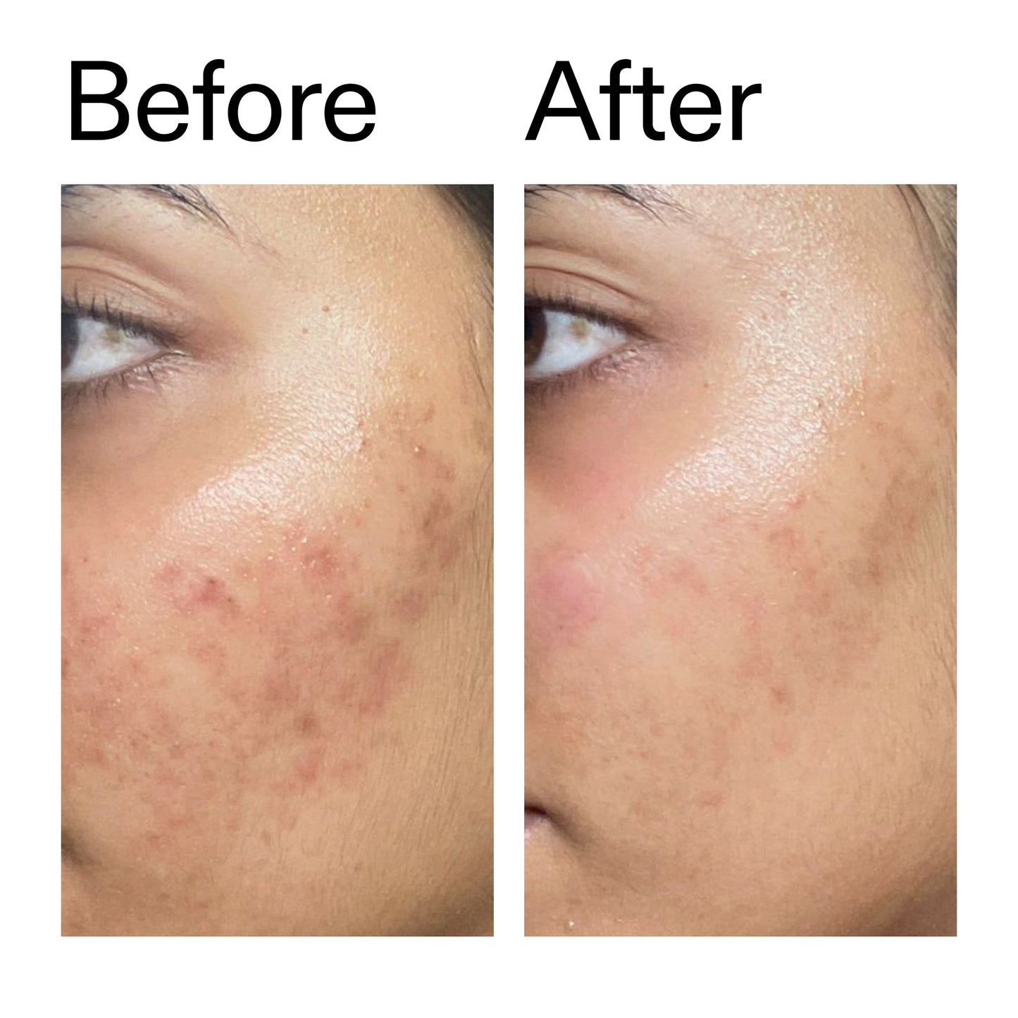 ectoin-hydro-barrier-serum-o3 Ectoin_Hydro-barrier_Serum__Before_After_2000x2000_34261920-d004-48d0-9c7b-8e1c15971bfd.jpg