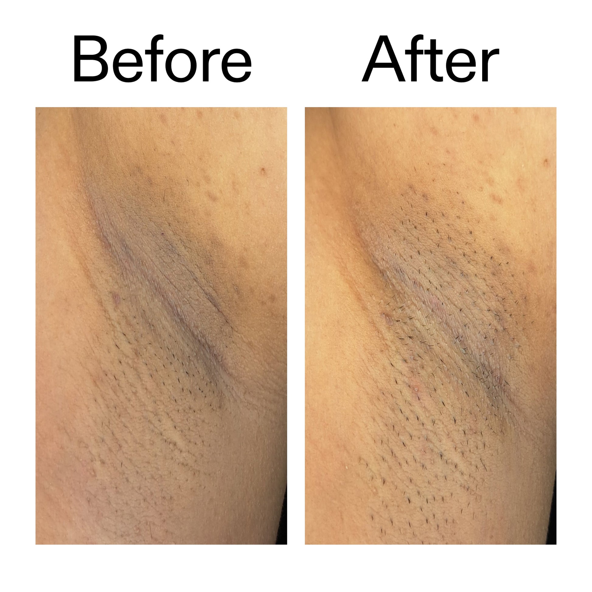 glycolic-acid-exfoliating-body-stick-k4 Glycolic_Acid_Exfoliating_Body_Stick_Before_After_V3_2000x2000_ea919cd9-1439-4a46-82a0-76200eb5bb42.jpg