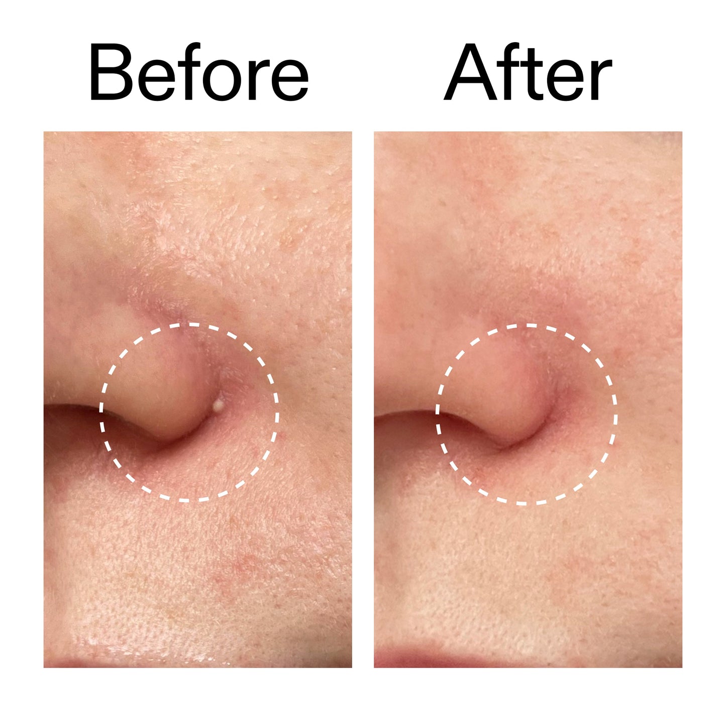 hydrocolloid-invisible-pimple-patches-pack-of-44-c3 Hydrocolloid_Invisible_Pimple_Patches_Before_After_2000x2000_b02aa37b-c78a-4682-91de-9135af5bb7df.jpg