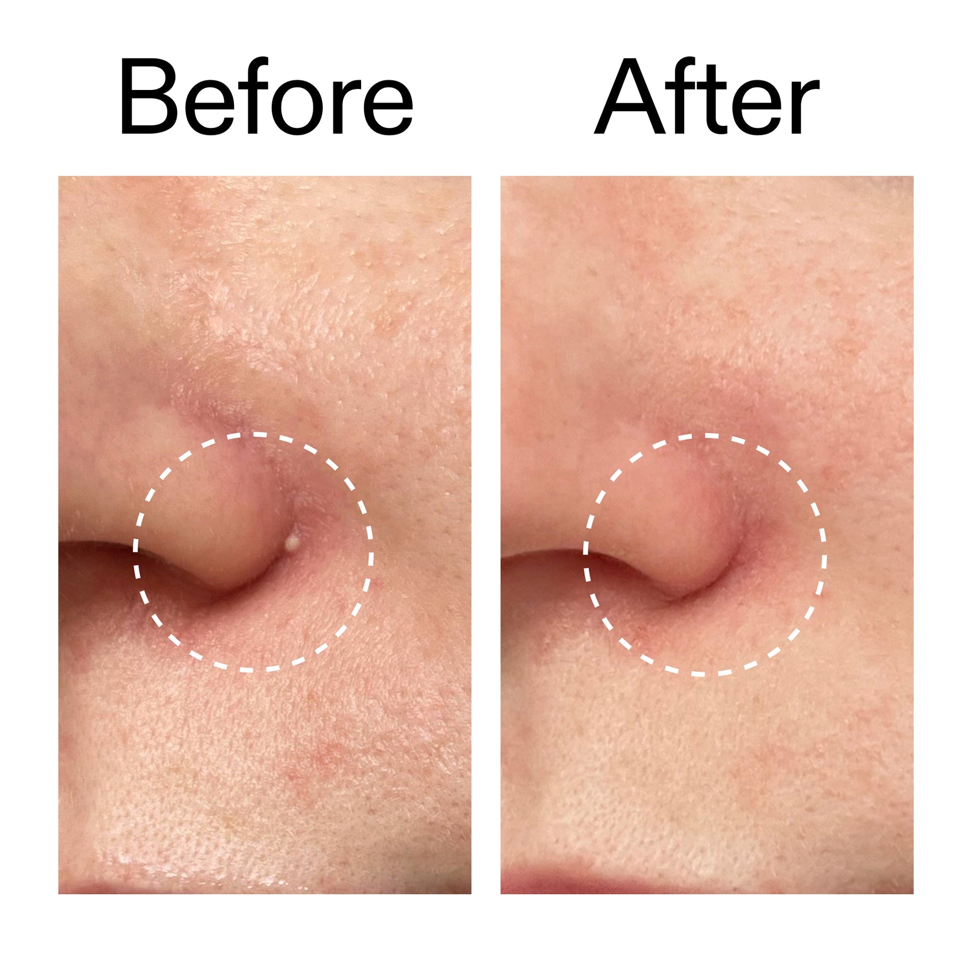 hydrocolloid-invisible-pimple-patches-pack-of-44-c3 Hydrocolloid_Invisible_Pimple_Patches_Before_After_2000x2000_b02aa37b-c78a-4682-91de-9135af5bb7df.jpg