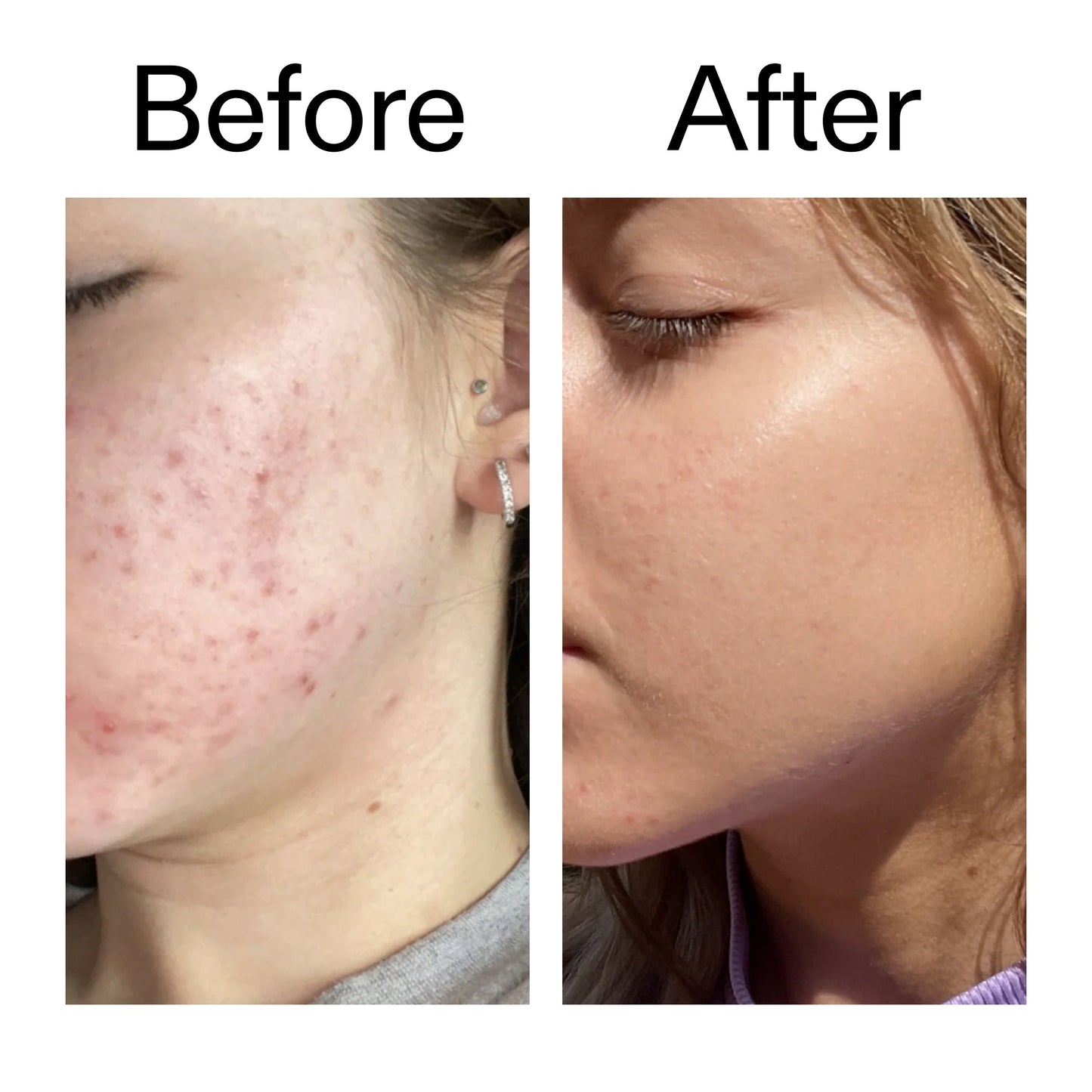 10-niacinamide-serum-e3 Niacinamide_Serum_Before_After_2000x2000_bde32455-9e7d-448e-b053-bef41504f0a9.jpg