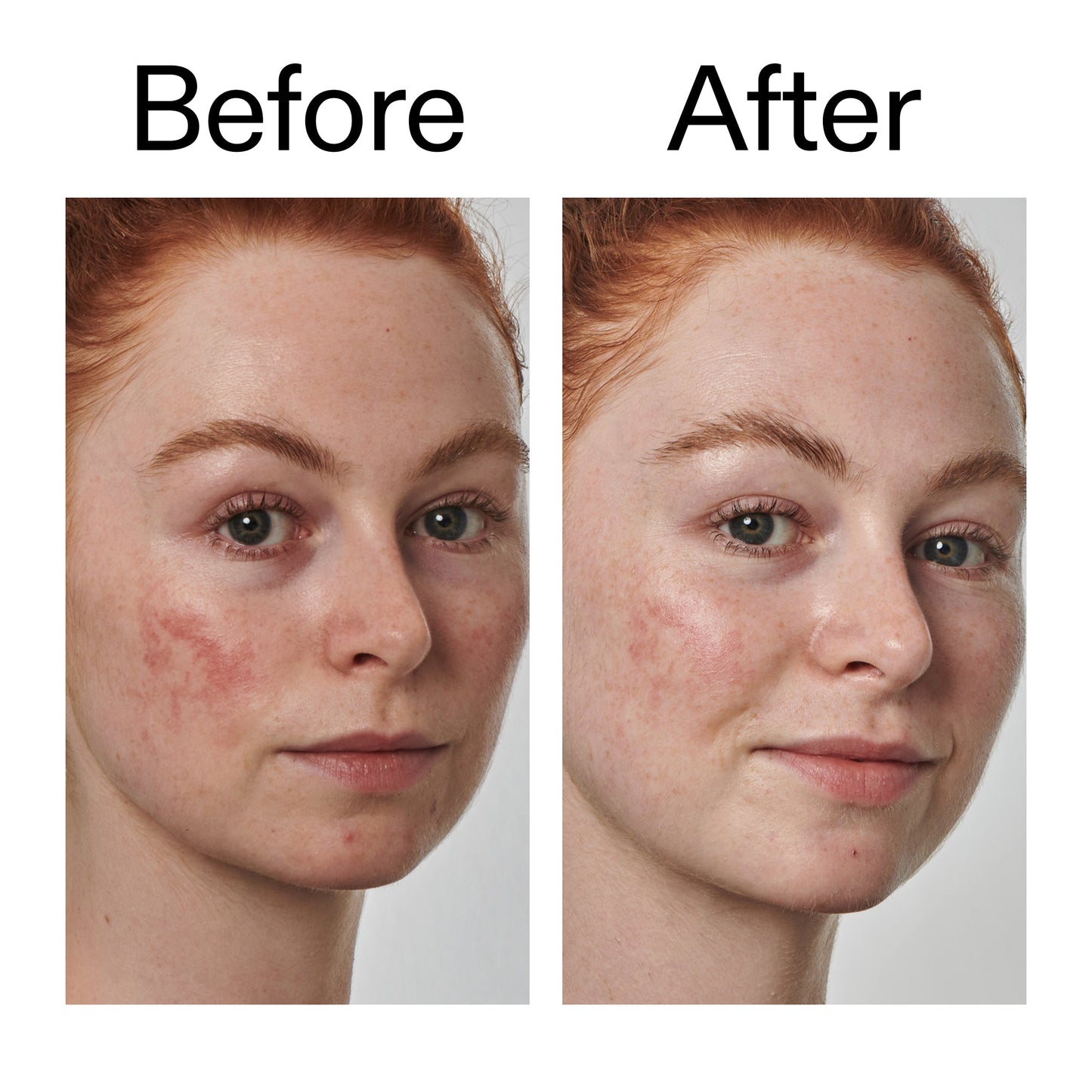 10-azelaic-acid-serum-for-redness-relief-e5 Redness_Relief_Serum_Before_After_2000x2000_3334dc9a-cce9-4e00-8aec-7ad89ca051f2.jpg