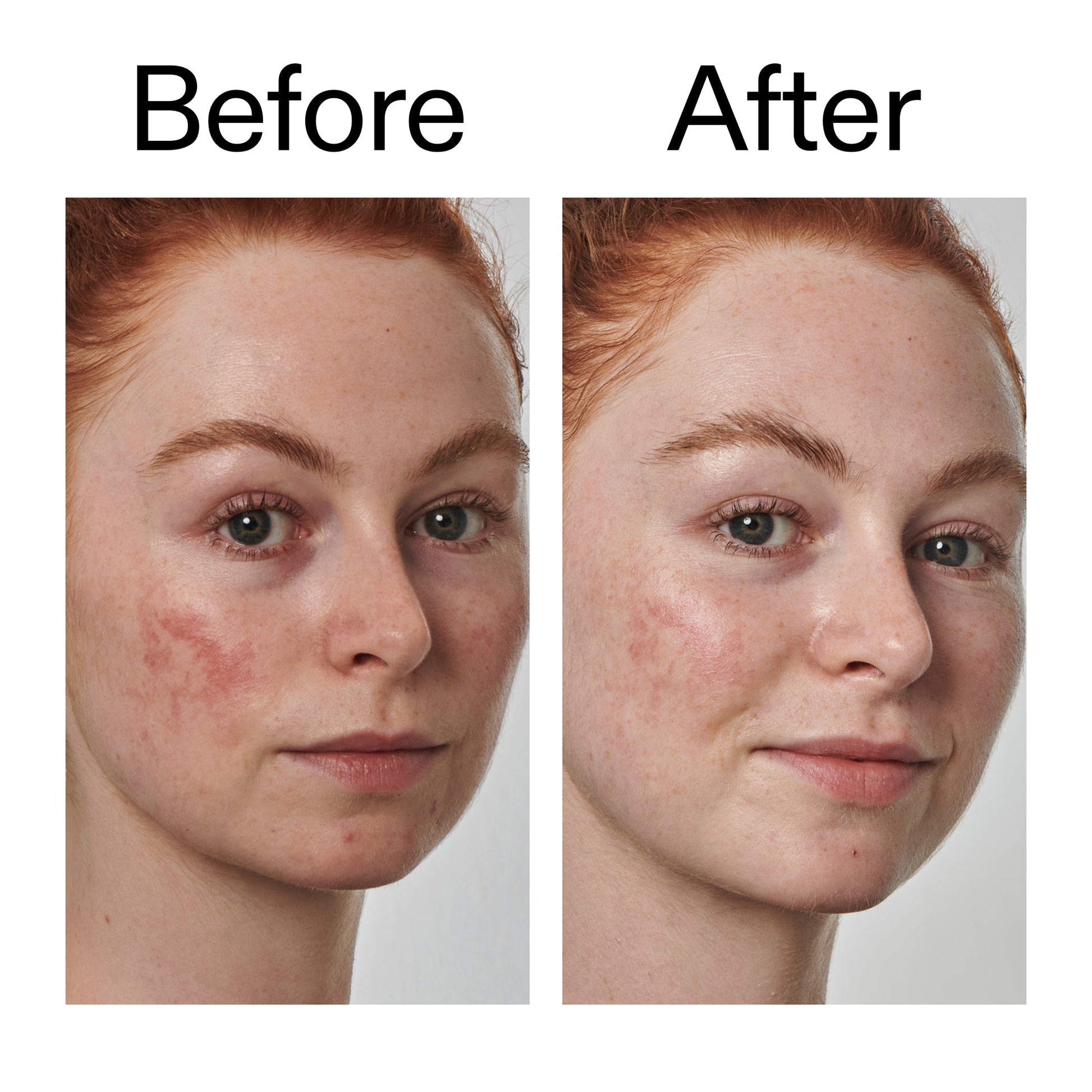 10-azelaic-acid-serum-for-redness-relief-e5 Redness_Relief_Serum_Before_After_2000x2000_3334dc9a-cce9-4e00-8aec-7ad89ca051f2.jpg