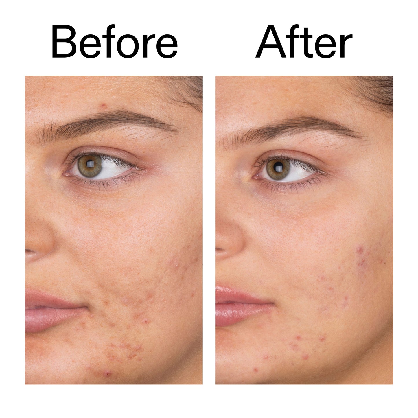 salicylic-acid-cleanser-150ml-x7 Salicylic_Acid_Cleanser_-_150ml_Before_After_2000x2000_e7230494-853f-4b07-82b1-27669104c995.jpg