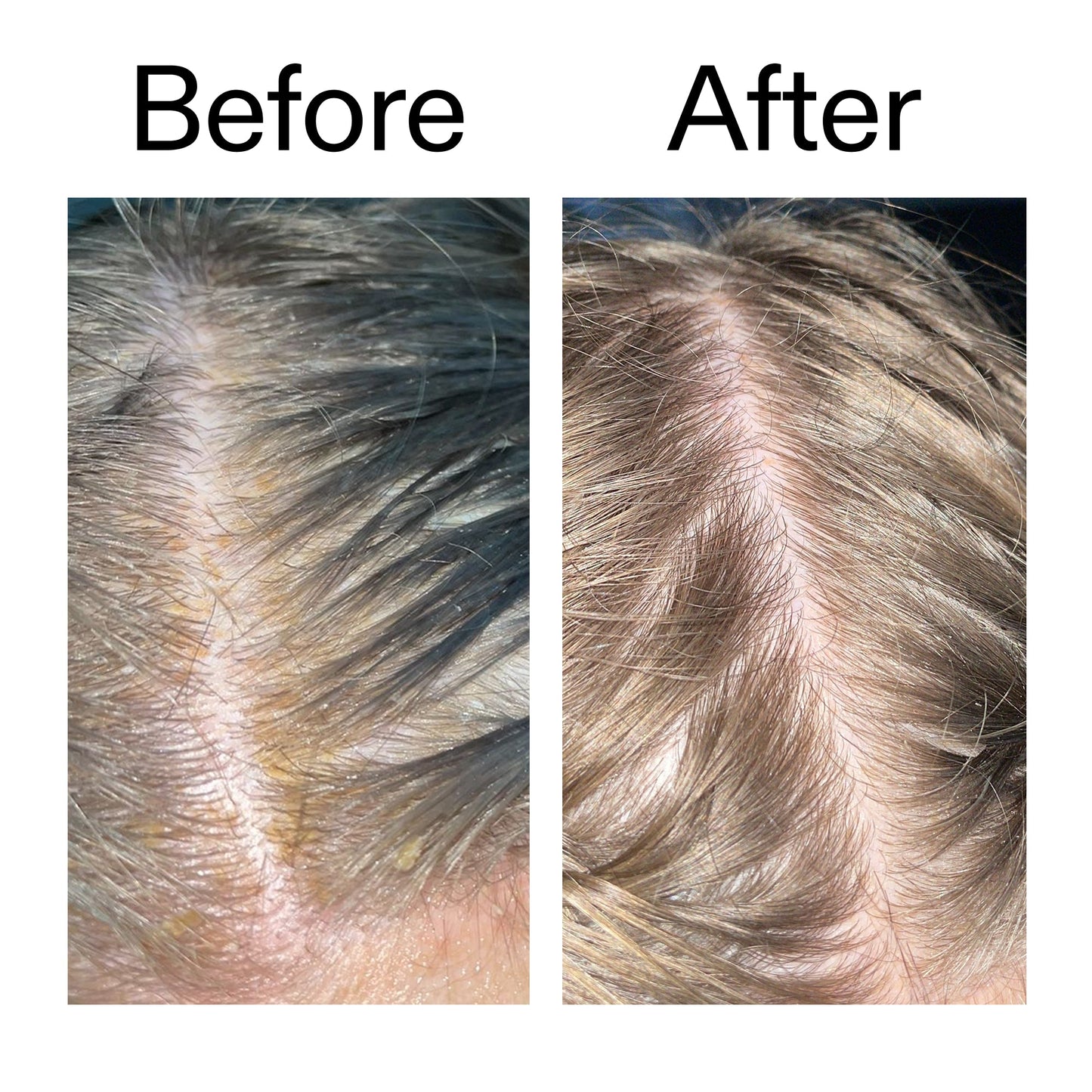 salicylic-acid-exfoliating-scalp-treatment-k1 Salicylic_Acid_Exfoliating_Scalp_Treatment_Before_After_2000x2000_e572a30f-057c-4a48-823b-1c09dc97f8d0.jpg
