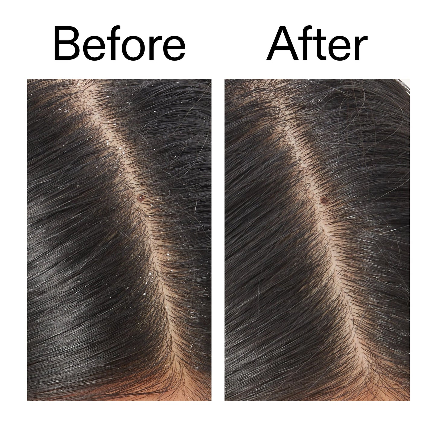 salicylic-acid-exfoliating-scalp-treatment-k1 Salicylic_Acid_Exfoliating_Scalp_Treatment_Before_After_V2_2000x2000_02bd61ad-42bf-490b-b3e3-7e04b2e8a673.jpg