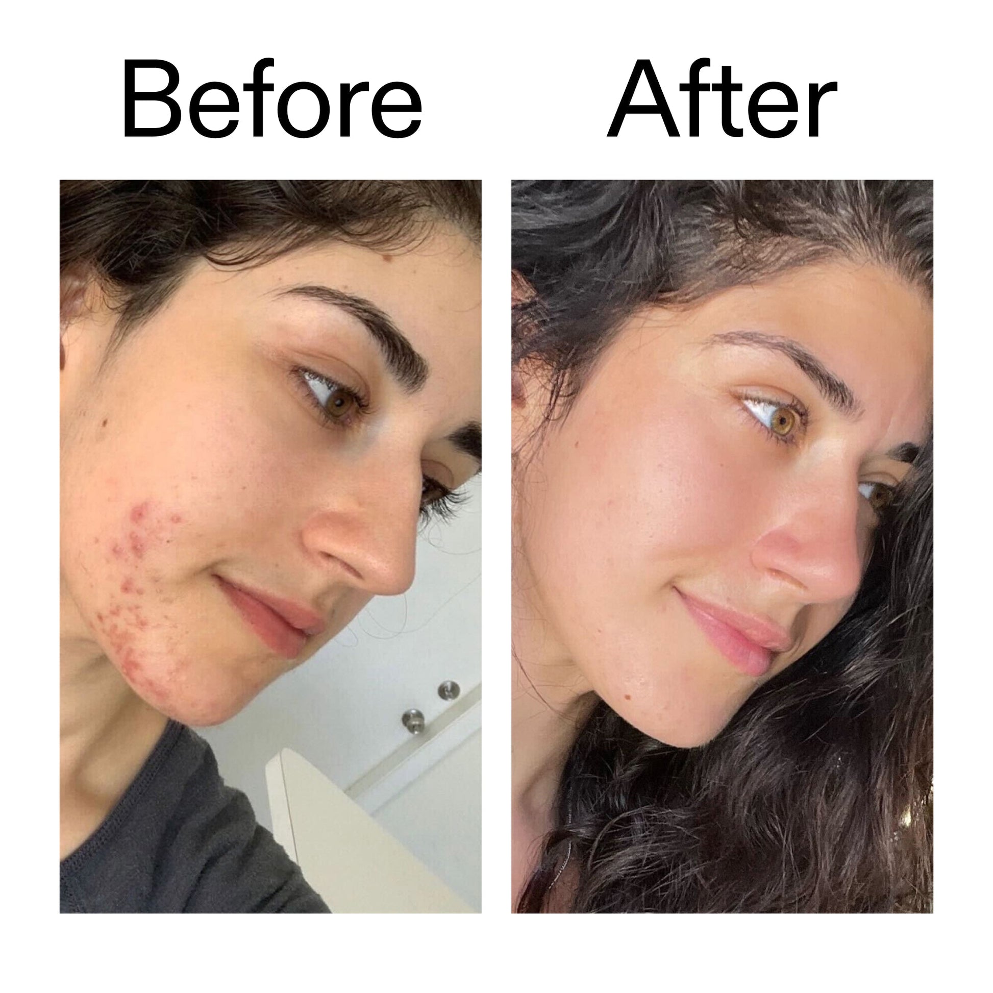 succinic-acid-acne-treatment-y1 Succinic_Acid_Treatment_Before_After_2000x2000_6a5f0054-2f58-4433-9314-0dc72c9bdd3b.jpg
