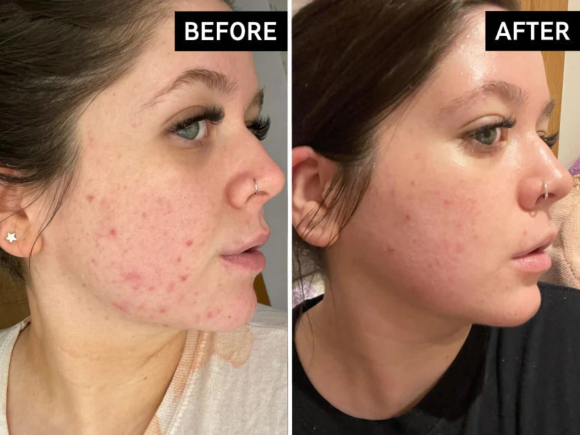 Before and after skin results