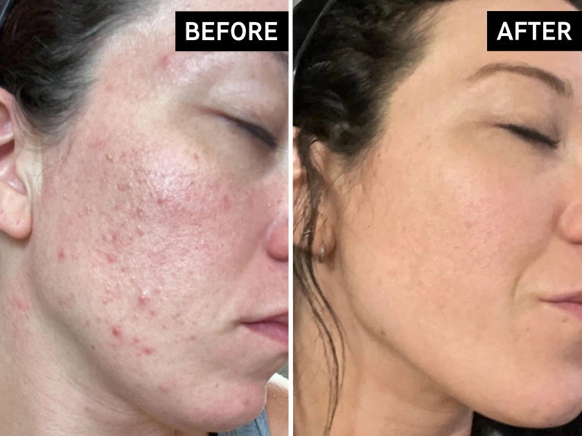 Before and after skin results
